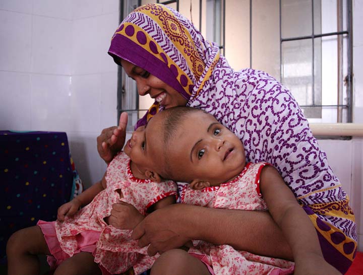 পাবনায় জন্ম নেয়া জোড়া দুই শিশু রাজধানীর বঙ্গবন্ধু মেডিকেলে চিকিৎসাধীন। 