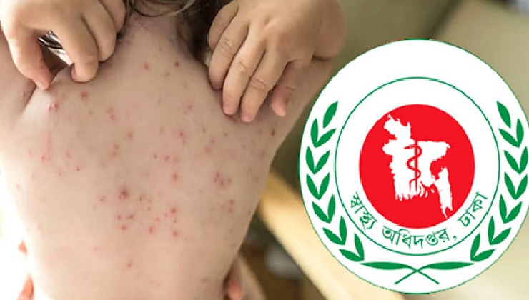 হাম উপসর্গে আরও ৩ জনের মৃত্যু